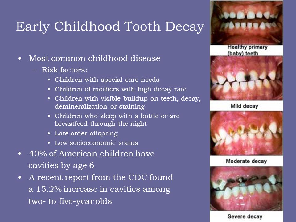 stages of tooth decay in children